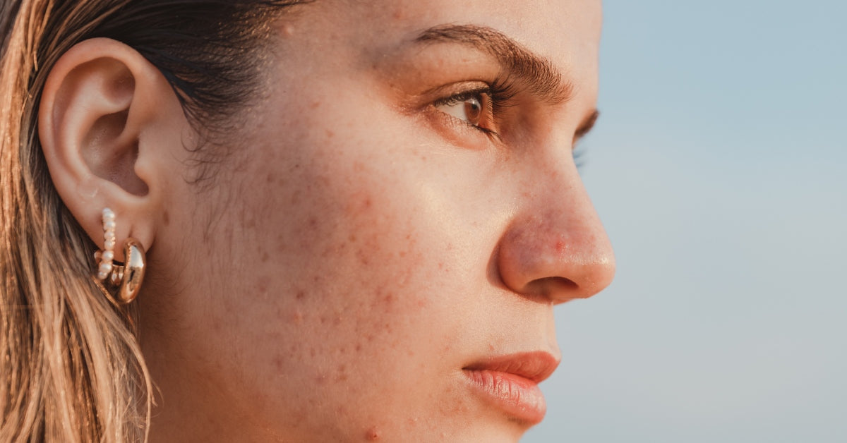  Say Goodbye to Acne with Infinity’s Proven Skincare Routine